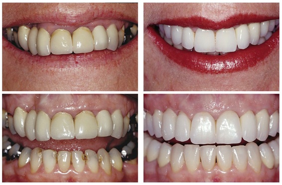 veneers before and after buck teeth