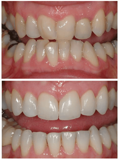 How Fast Can My Teeth Be Straightened?